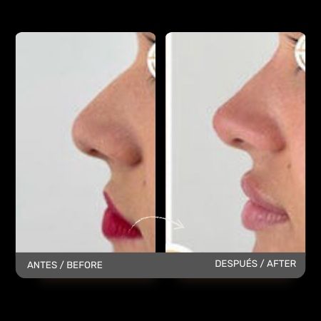 Non surgical nose job